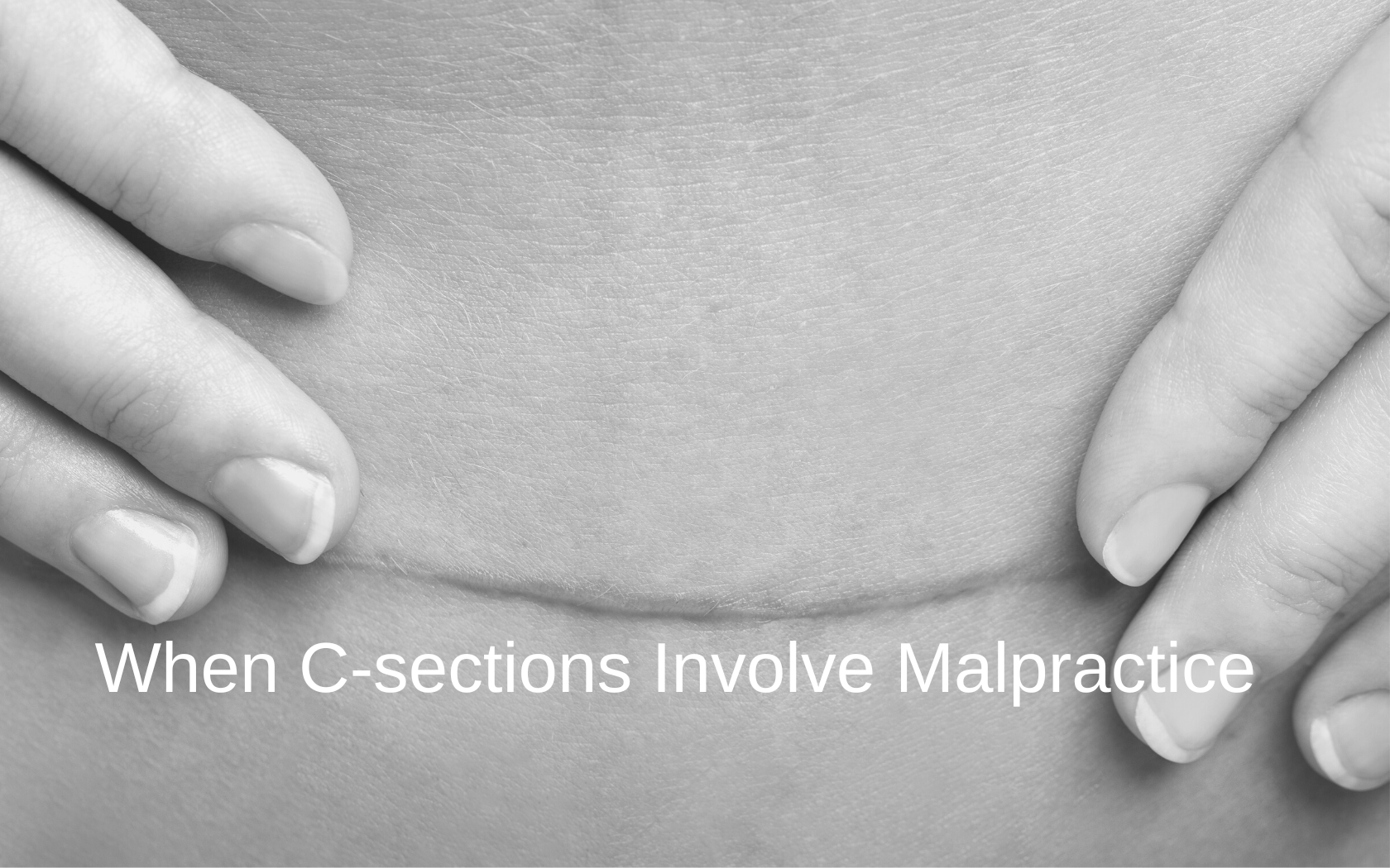 Internal Bleeding After C-section: A Consequence of Malpractice